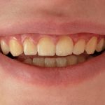 Why Are My Teeth Turning Yellow? Causes and Fixes from Your Dentist Brighton