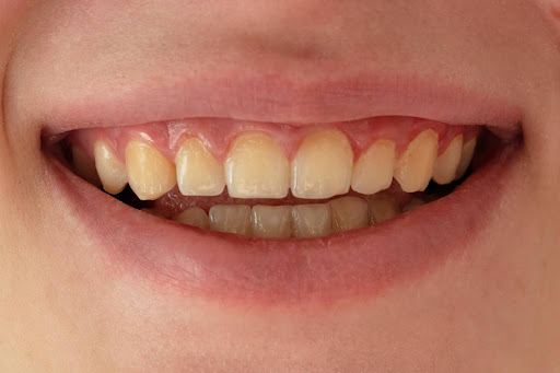 Why Are My Teeth Turning Yellow? Causes and Fixes from Your Dentist Brighton
